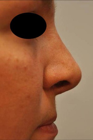 Patsient-1.-Nina-kühmu-eemaldamine.-Peale-operatsiooni