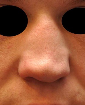 Patsient 2. Ninaplastika. Enne operatsiooni 