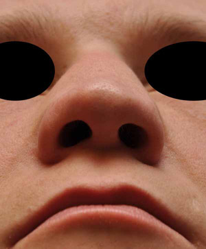 Patsient 2. Ninaplastika. Enne operatsiooni 