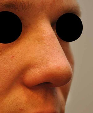 Patsient 2. Ninaplastika. Peale operatsiooni 