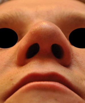 Patsient 2. Ninaplastika. Peale operatsiooni 