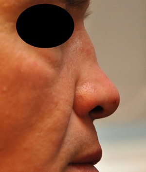 Patsient-3.-Sadulnina-korrigeerimine.-Enne-operatsiooni