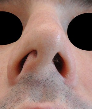 Patsient-4.-Ninaplastika.-Enne-operatsiooni