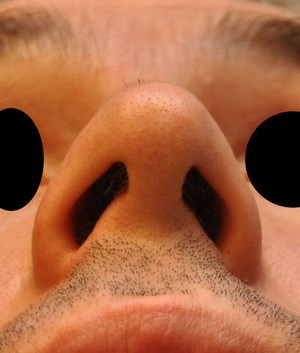 Patsient-4.-Ninaplastika.-Peale-operatsiooni