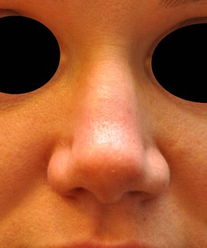 Patsient 5. Peale operatsiooni