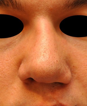 Patsient 6. Peale operatsiooni