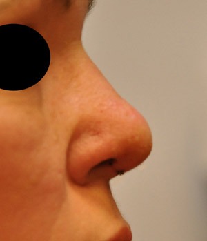 Patsient 7. Peale operatsiooni