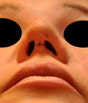 Patsient 7. Peale operatsiooni